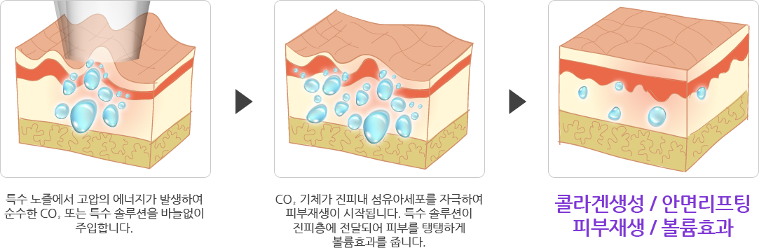 1. 특수 노즐에서 고압의 에너지가 발생하여 순수한 CO2, 또는 특수 솔루션을 바늘없이 주입합니다. 2. CO2 기체가 진피내 섬유아세포를 자극하여 피부재생이 시작됩니다. 특수 솔루션이 진피층에 전달되어 피부를 탱탱하게 볼륨효과를 줍니다. 3. 콜라겐생성 / 안면리프팅 피부재생 / 볼륨효과
